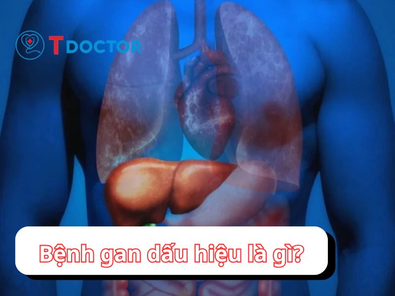 Bệnh gan dấu hiệu: nhận biết để phòng biến chứng