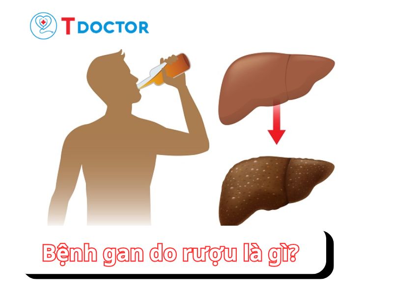 Bệnh gan do rượu: dấu hiệu và biến chứng