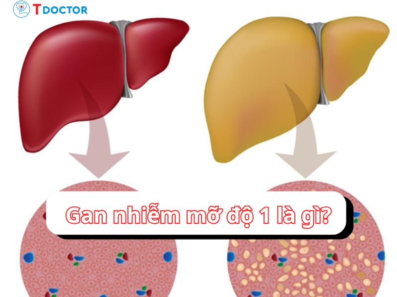 Tất tần tật về gan nhiễm mỡ độ 1 mà bạn cần phải biết