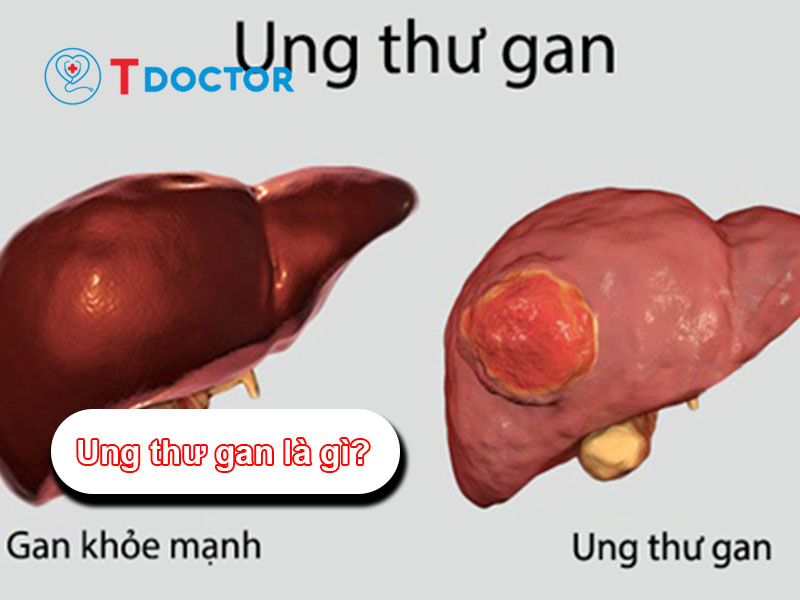 Ung thư gan là gì? và những điều quan trọng bạn cần phải biết