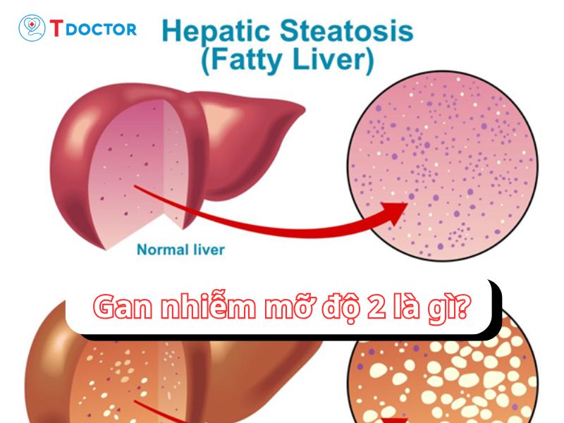 Gan nhiễm mỡ độ 2: tình trạng không thể chủ quan