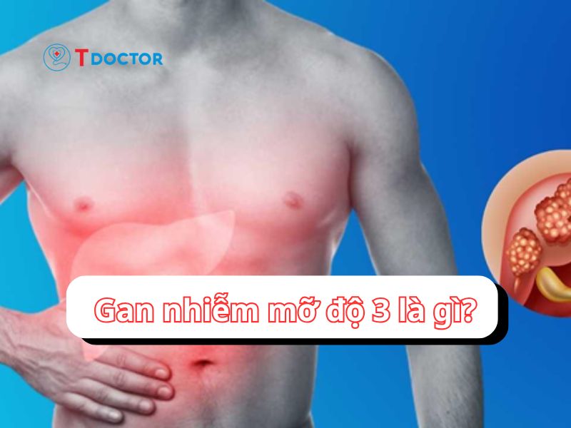 Gan nhiễm mỡ độ 3 giai đoạn nguy hiểm không thể chủ quan 