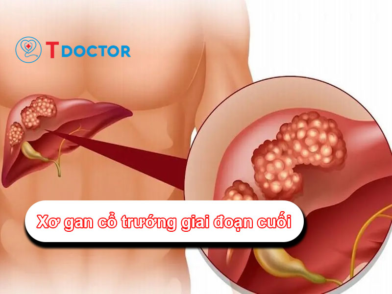 [ Cảnh báo] Các triệu chứng xơ gan cổ trướng giai đoạn cuối 