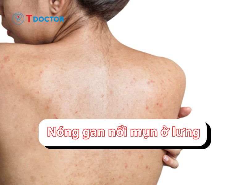  Nóng gan nổi mụn ở lưng? Báo động của giảm chức năng gan 