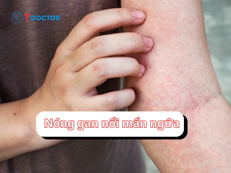 Bật mí "Nóng gan nổi mẩn ngứa phải làm sao?" 