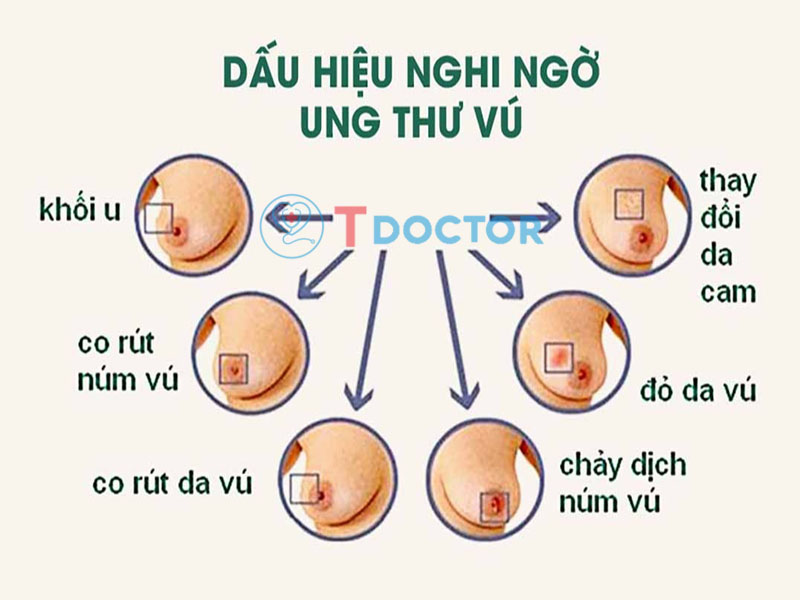 7 triệu chứng báo hiệu ung thư vú mà bạn cần phải biết