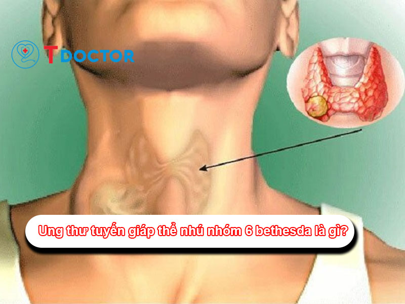 Ung thư tuyến giáp thể nhú nhóm 6 bethesda là gì?