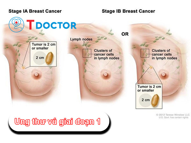 Những thông tin quan trọng về bệnh "Ung thư vú giai đoạn 1"