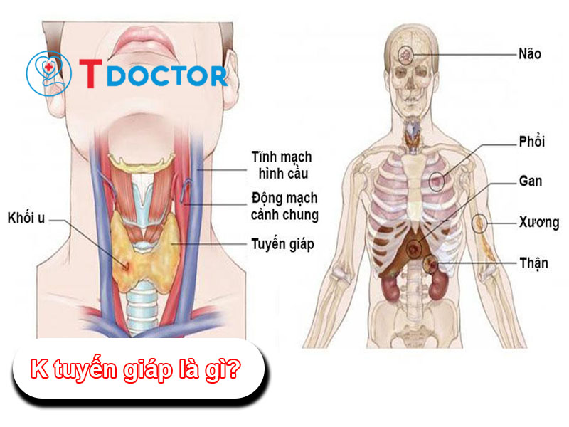 K tuyến giáp là gì? Nguyên nhân gây nên K tuyến giáp