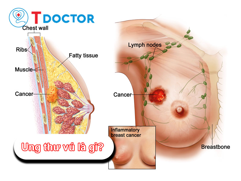Ung thư vú là gì? Những nguyên nhân dẫn tới bệnh này