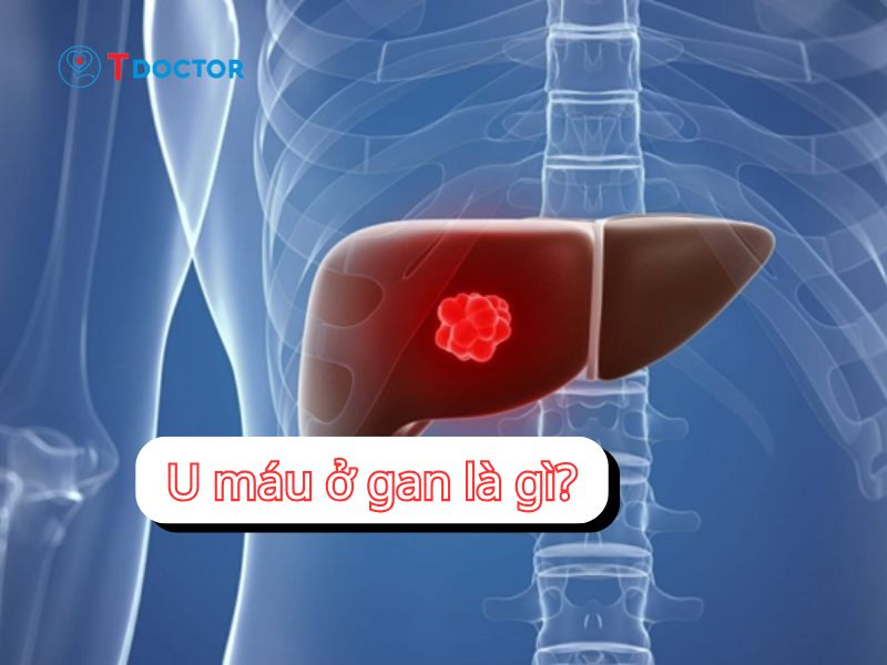 Tất tần tật về u máu ở gan nhất định bạn cần biết