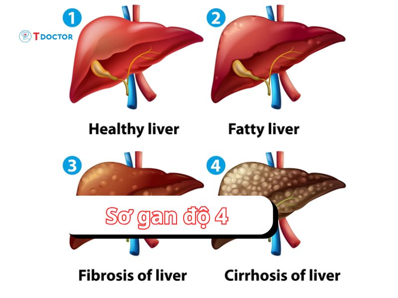 Trả lời câu hỏi: "Xơ gan độ 4 có chữa được không"
