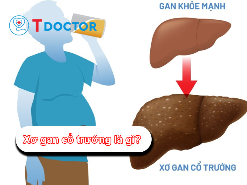 Xơ gan cổ trướng là gì? Các triệu chứng đầu tiên của bệnh này