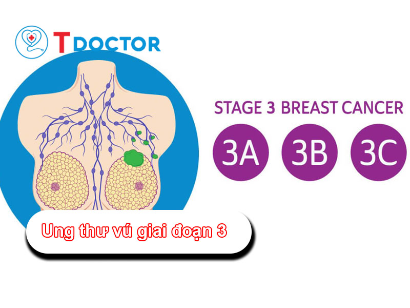 Ung thư vú giai đoạn 3: Triệu chứng, điều trị và tiên lượng