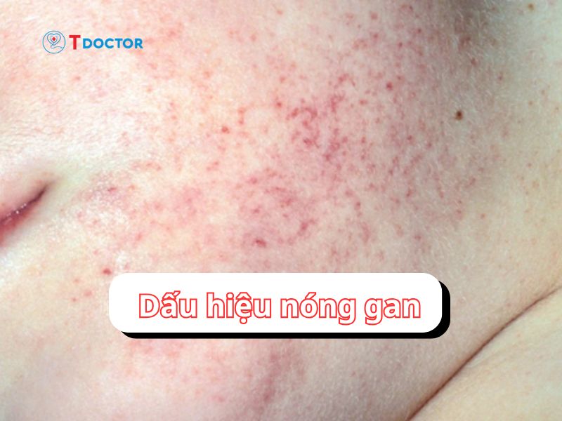 Các dấu hiệu nóng gan có thể bạn chưa biết 