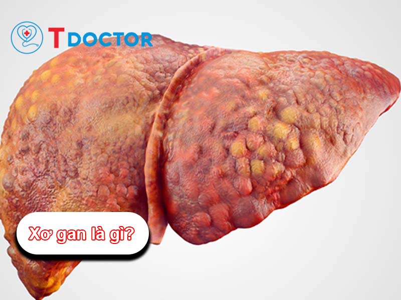 Xơ gan là gì? Những điều bạn cần biết về bệnh xơ gan