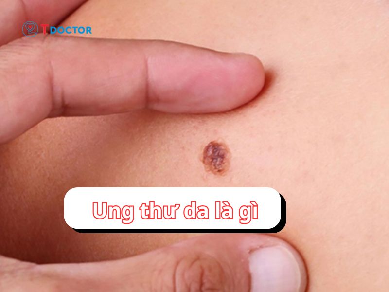 Ung thu da và những thông tin quan trọng không thể bỏ qua