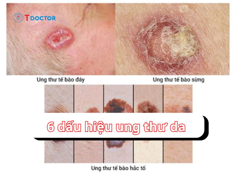 Nhận biết sớm 6 dấu hiệu của ung thư da