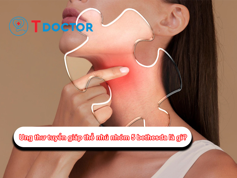 Những điều cần biết ung thư tuyến giáp thể nhú 5 Bethesda