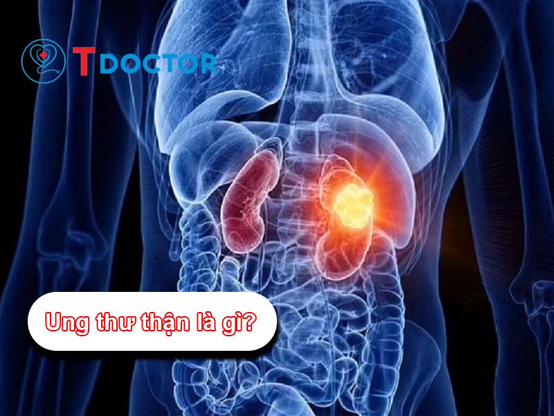 Ung thư thận: Những điều cần biết về căn bệnh nguy hiểm này