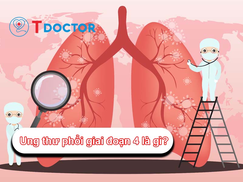 Ung thư phổi giai đoạn 4: Triệu chứng và phương pháp điều trị