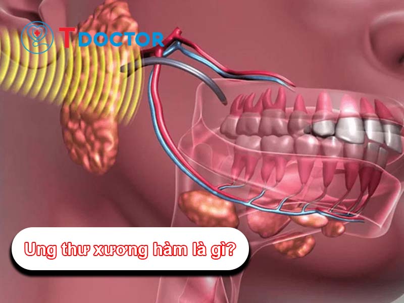 Ung thư xương hàm là gì? Nguyên nhân và triệu chứng bệnh