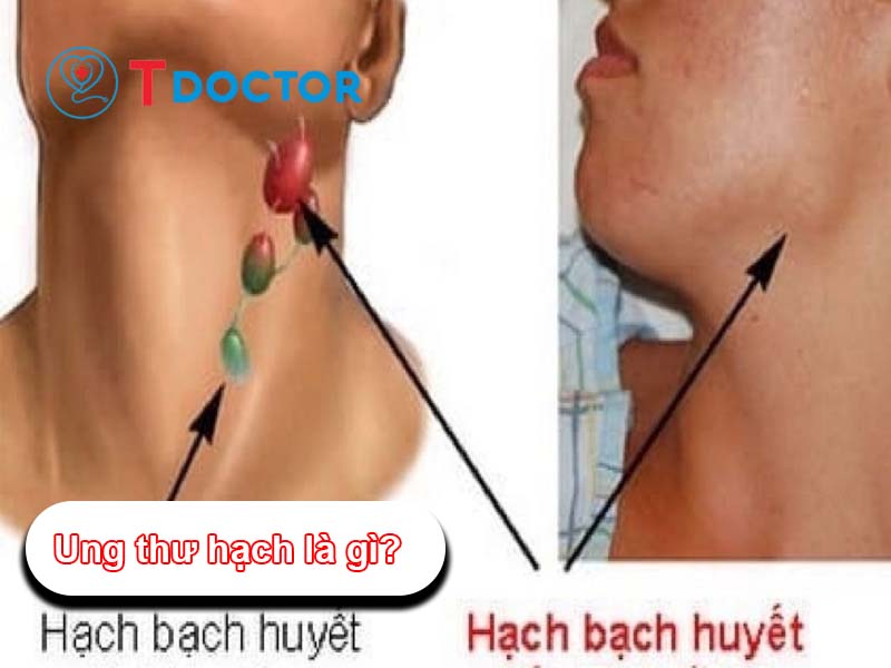 Ung thư hạch là gì?: Nguyên nhân, triệu chứng và cách điều trị