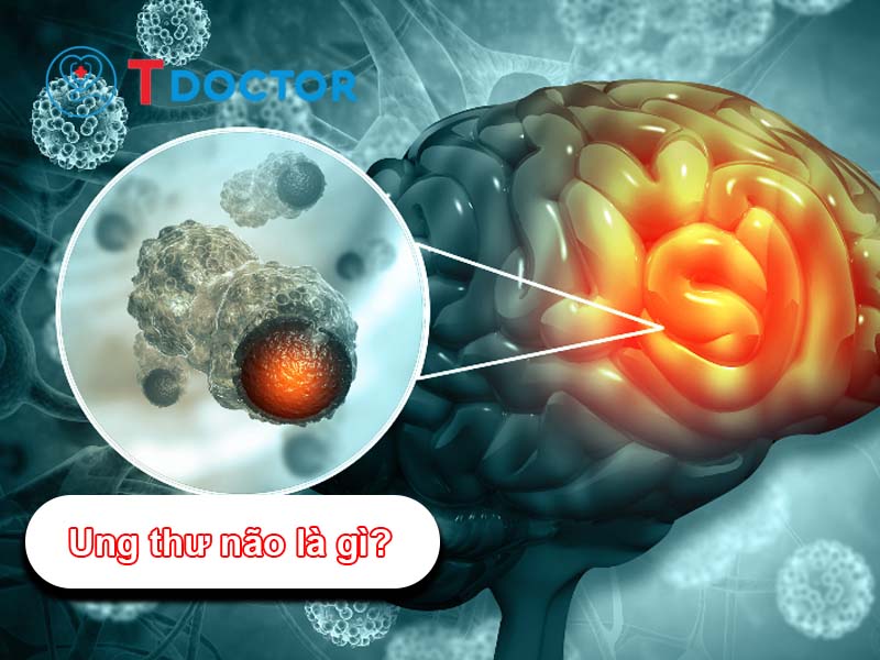 Ung thư não: Triệu chứng, nguyên nhân và cách điều trị hiệu quả