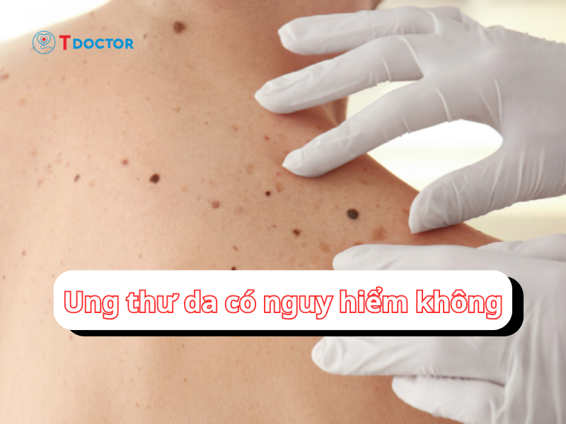 Giải đáp: "Ung thư da có nguy hiểm không?"