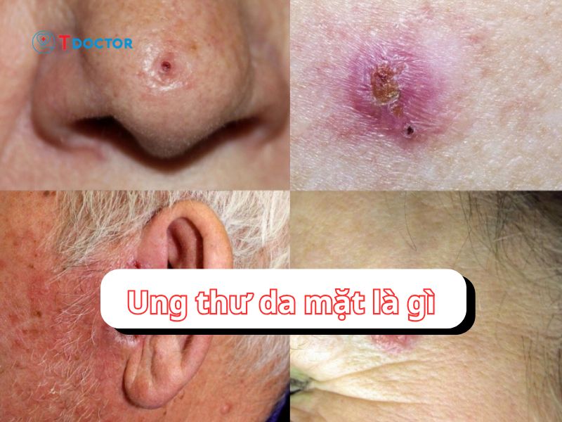 Tất tần tật thông tin về ung thư da mặt mà bạn cần biết