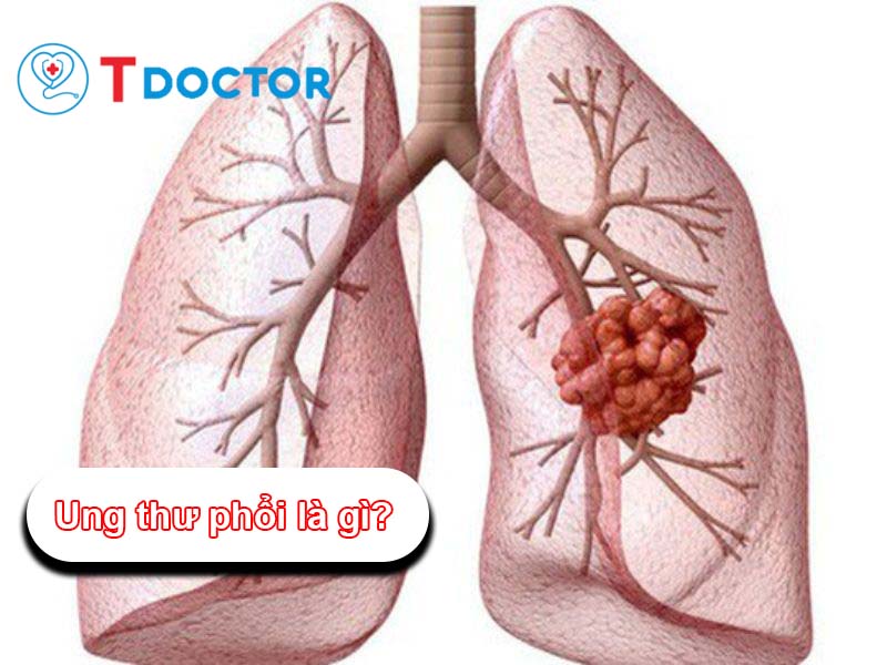 Ung thư phổi là gì? Các giai đoạn và nguyên nhân gây bệnh