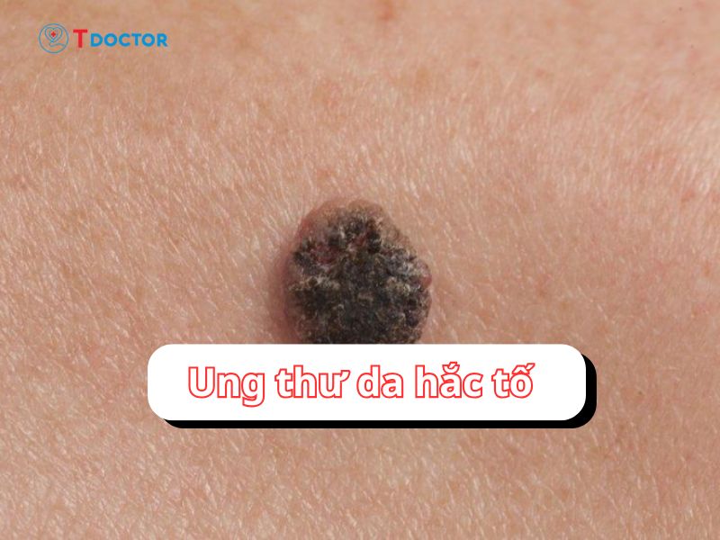 Ung thư da hắc tố: loại ung thư da nguy hiểm nhất