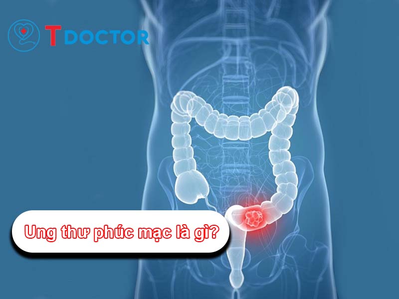 Ung thư phúc mạc là gì? Nguyên nhân, triệu chứng bệnh lý