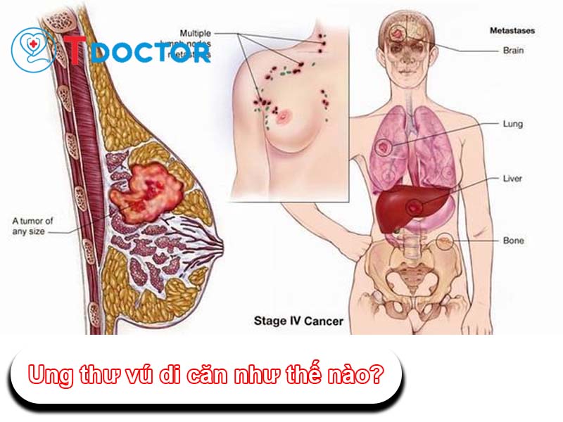 Ung thư vú di căn là như thế nào? và có mấy loại di căn