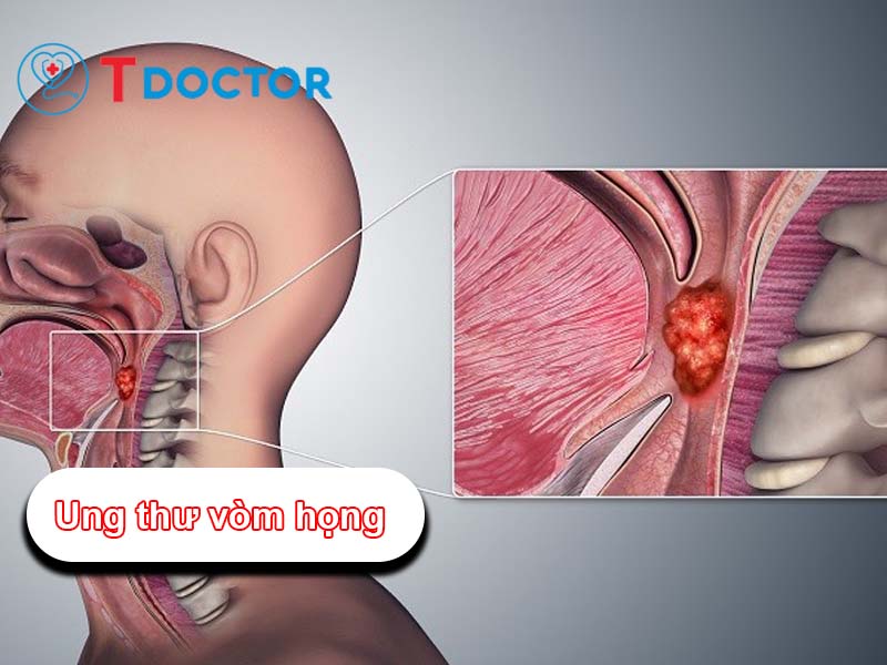 Nguyên nhân và đấu hiệu của ung thư vòm họng bạn cần biết