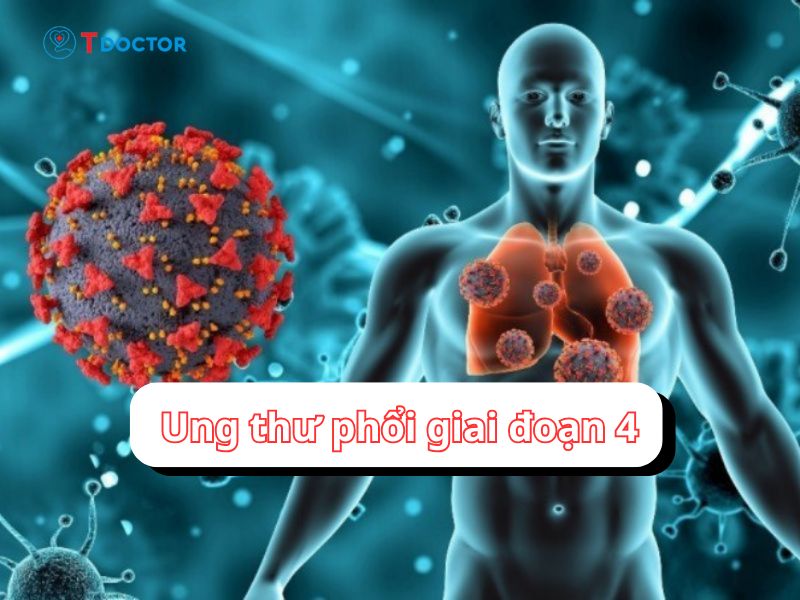 Ung thư phổi giai đoạn 4 là gì? Các dấu hiệu nhận biết