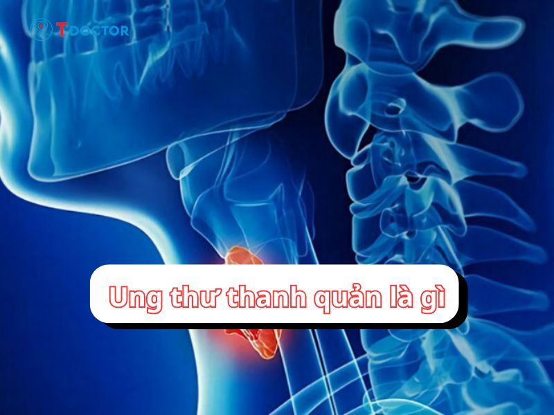 Thông tin quan trọng về ung thư thanh quản bạn cần biết