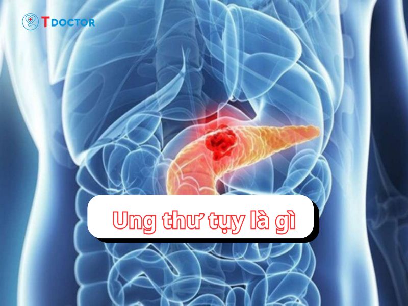 Ung thư tụy là gì? Nguyên nhân và có di truyền hay không?