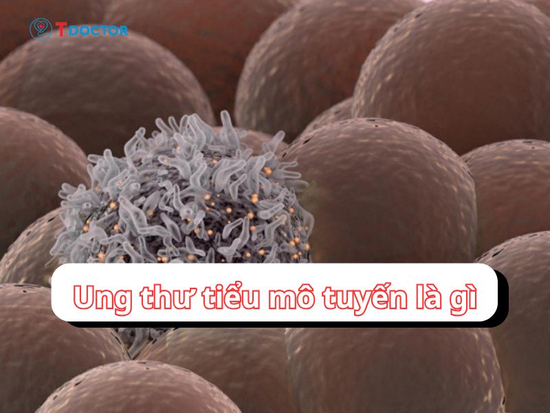Ung thư biểu mô tuyến là gì? Có chữa được hay không?