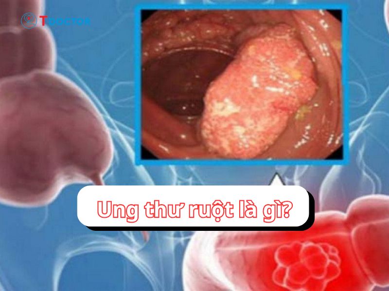 Ung thư ruột: Đặc điểm, triệu chứng và phương pháp điều trị