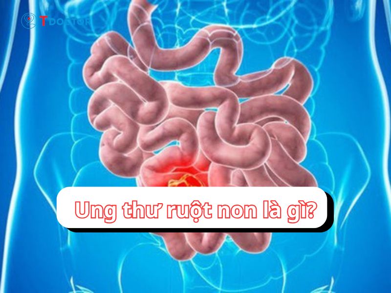 Bật mí những thông tin quan trọng về ung thư ruột non