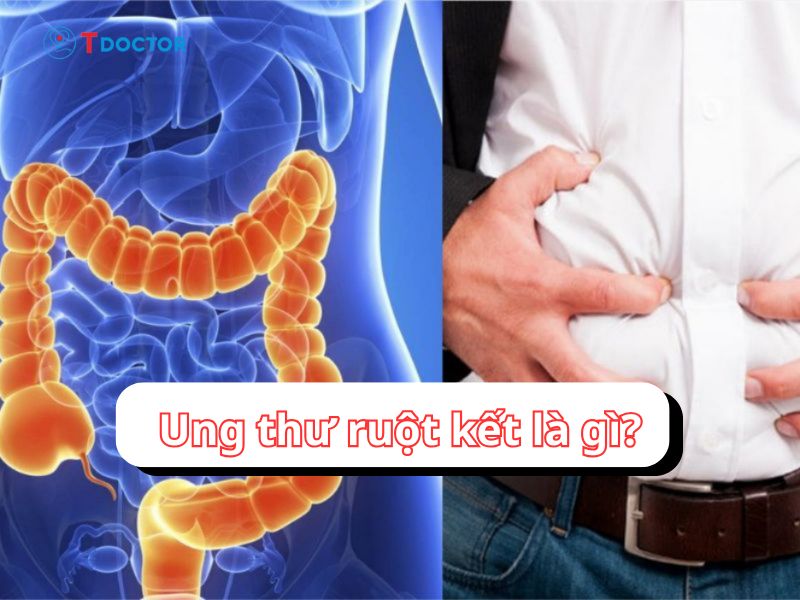Ung thư ruột kết là gì? Triệu chứng và điều trị như thế nào?