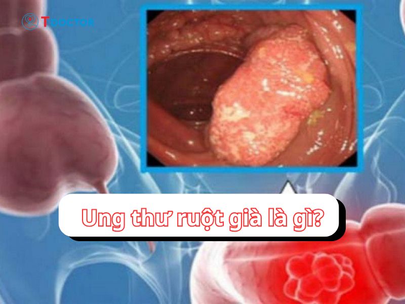 Ung thư ruột già: Dấu hiệu, nguyên nhân và cách điều trị