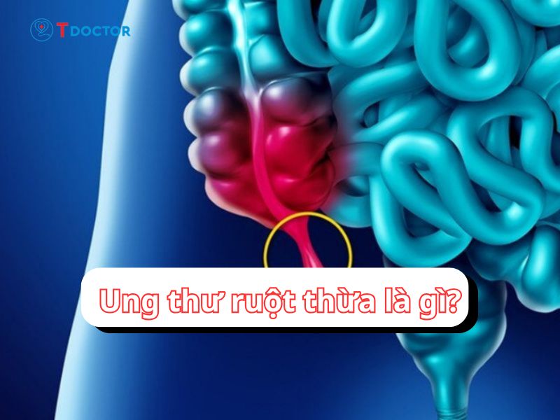 Bật mí những thông tin quan trọng về ung thư ruột thừa