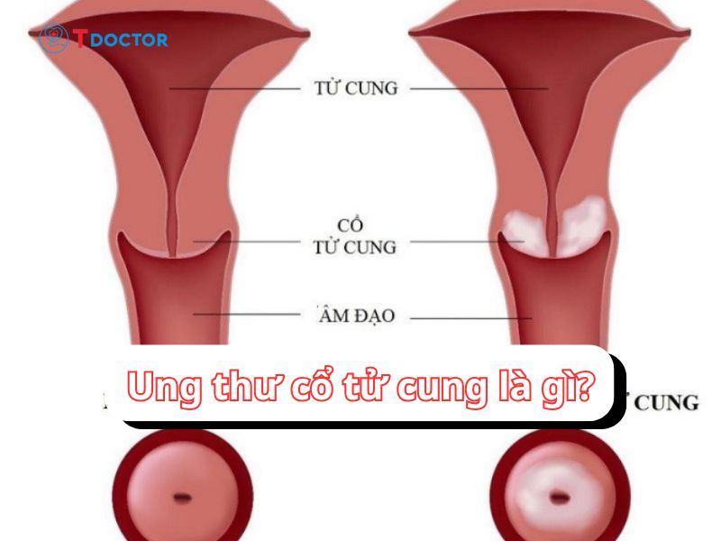 Chia sẻ tất tần tật thông tin quan trọng về ung thư cổ tử cung