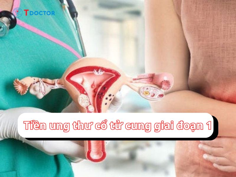 Tất tần tật về tiền ung thư cổ tử cung giai đoạn 1