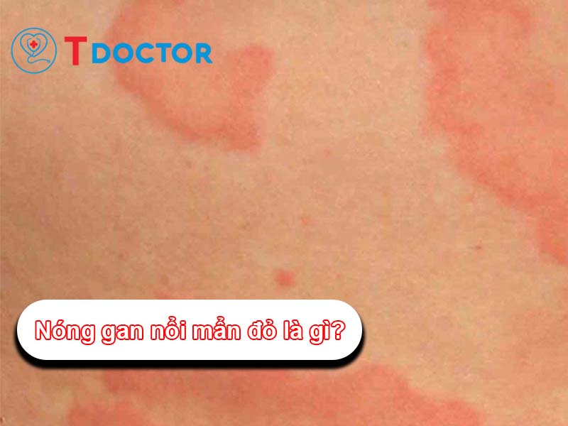 Tình trạng nóng gan nổi mẩn đỏ là gì? và cách xử lý như nào