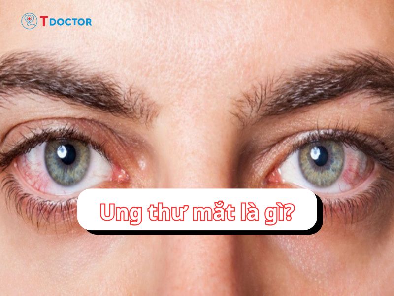 Ung thư mắt: Dấu hiệu nhận biết, cách chẩn đoán và điều trị