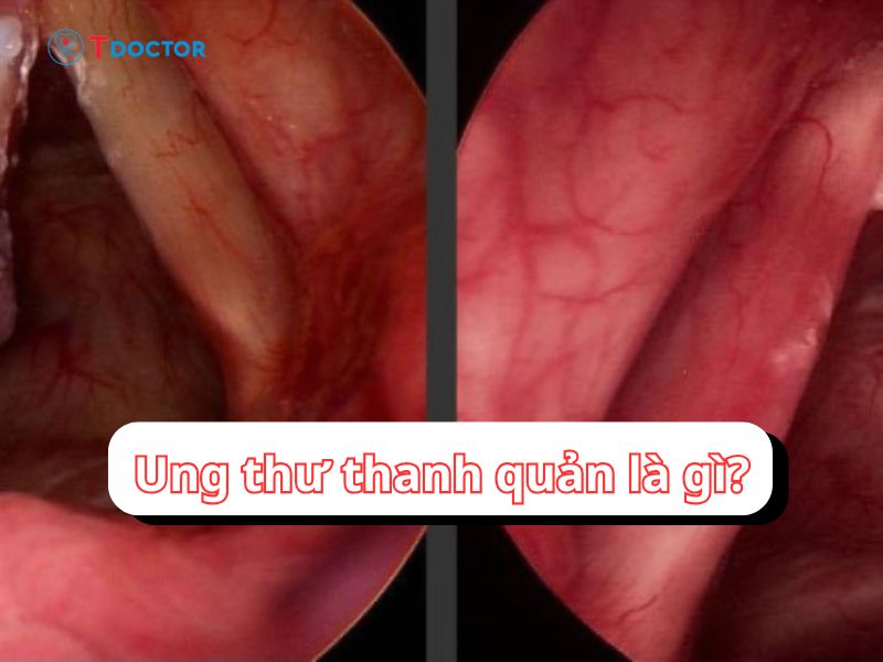 Những thông tin chi tiết về ung thư thanh quản