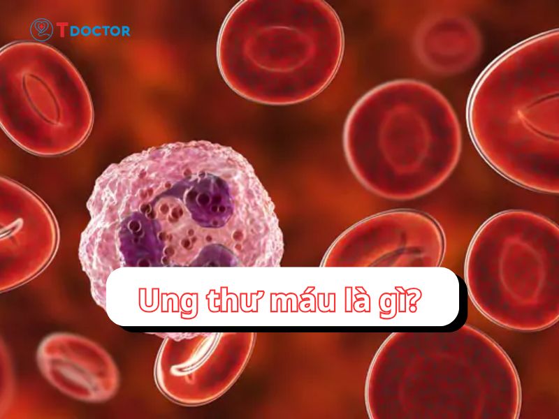 Ung thư máu do đâu? Những điều có thể bạn chưa biết